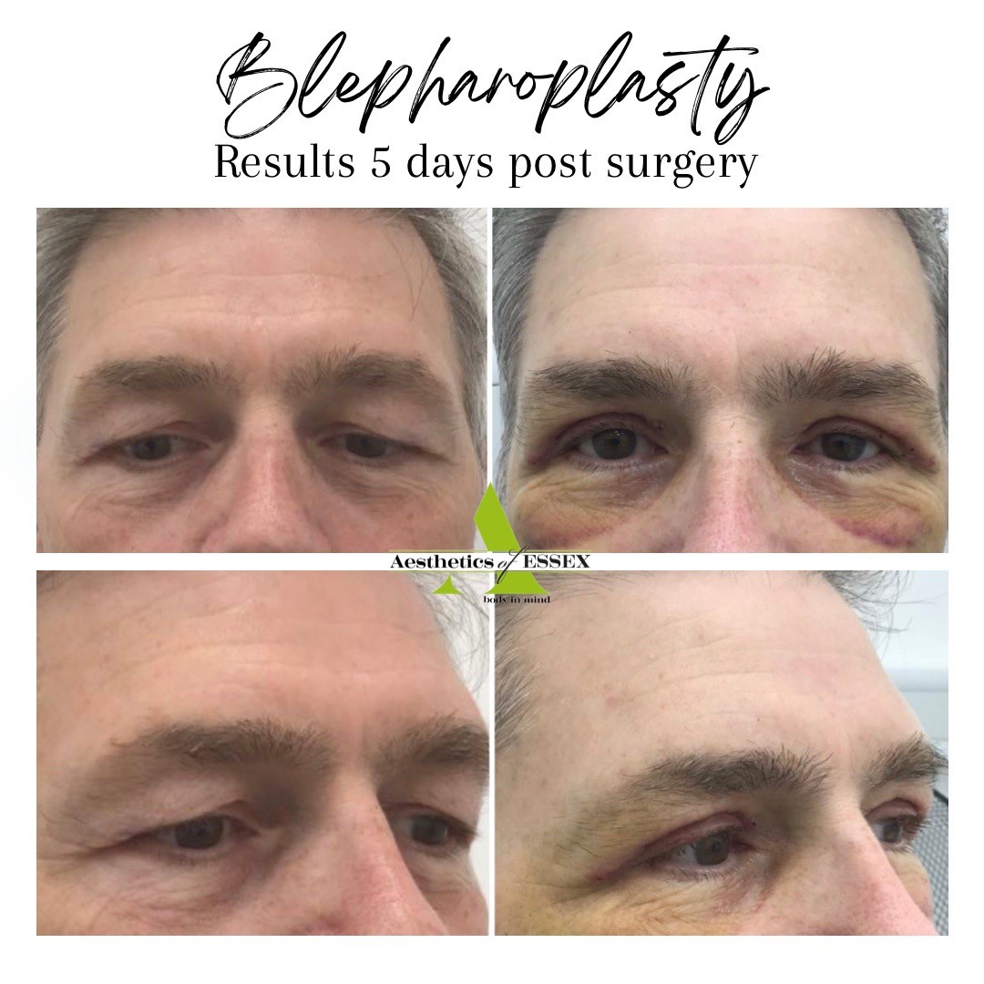 Blepharoplasty Essex