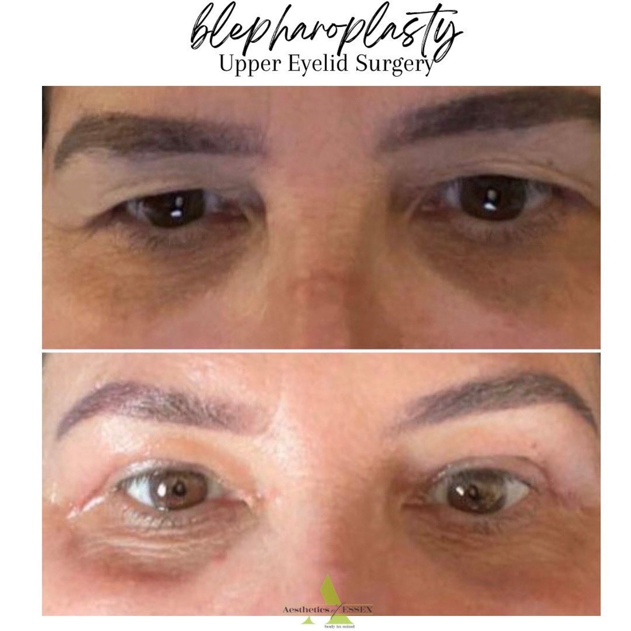 Blepharoplasty Essex