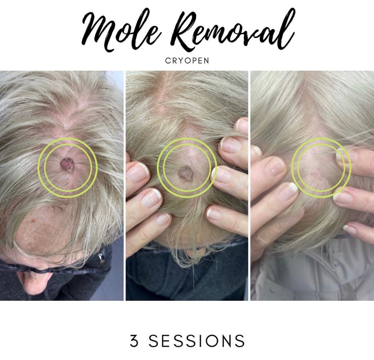 Mole Removal Essex