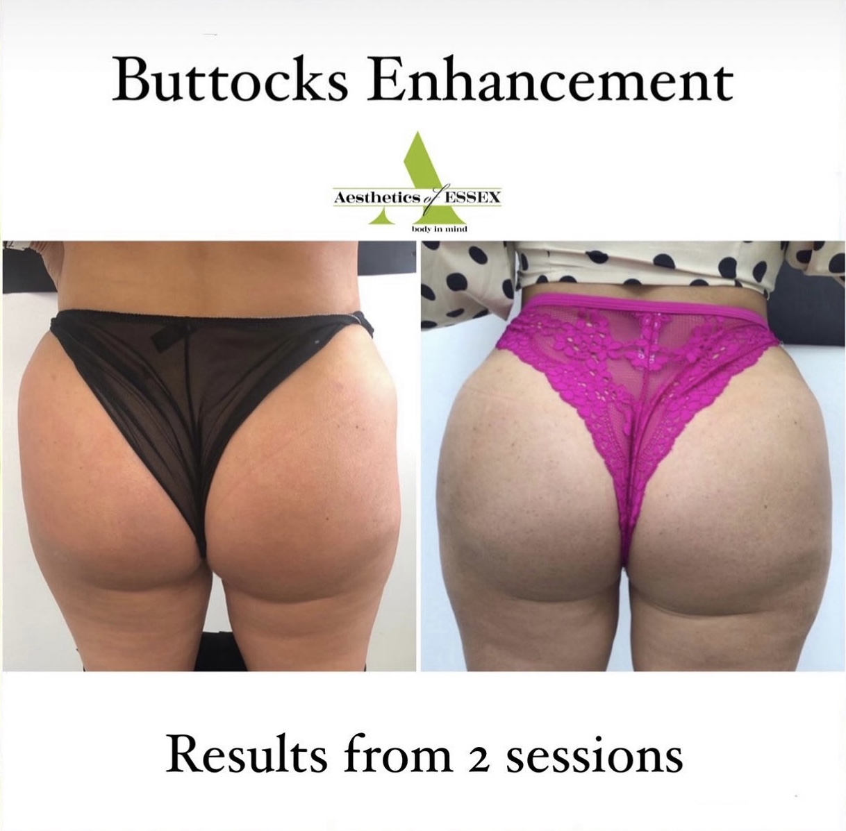 buttock enhancement