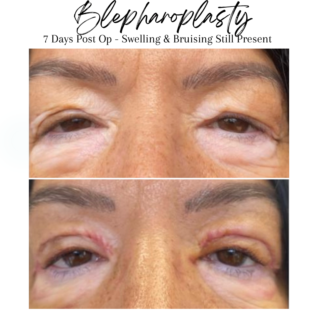 Blepharoplasty - Upper Eyelid Surgery