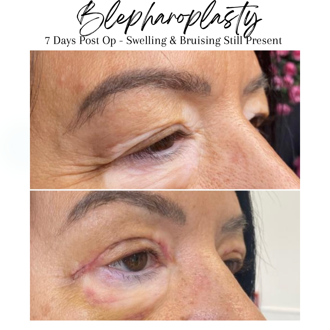 Blepharoplasty - Upper Eyelid Surgery