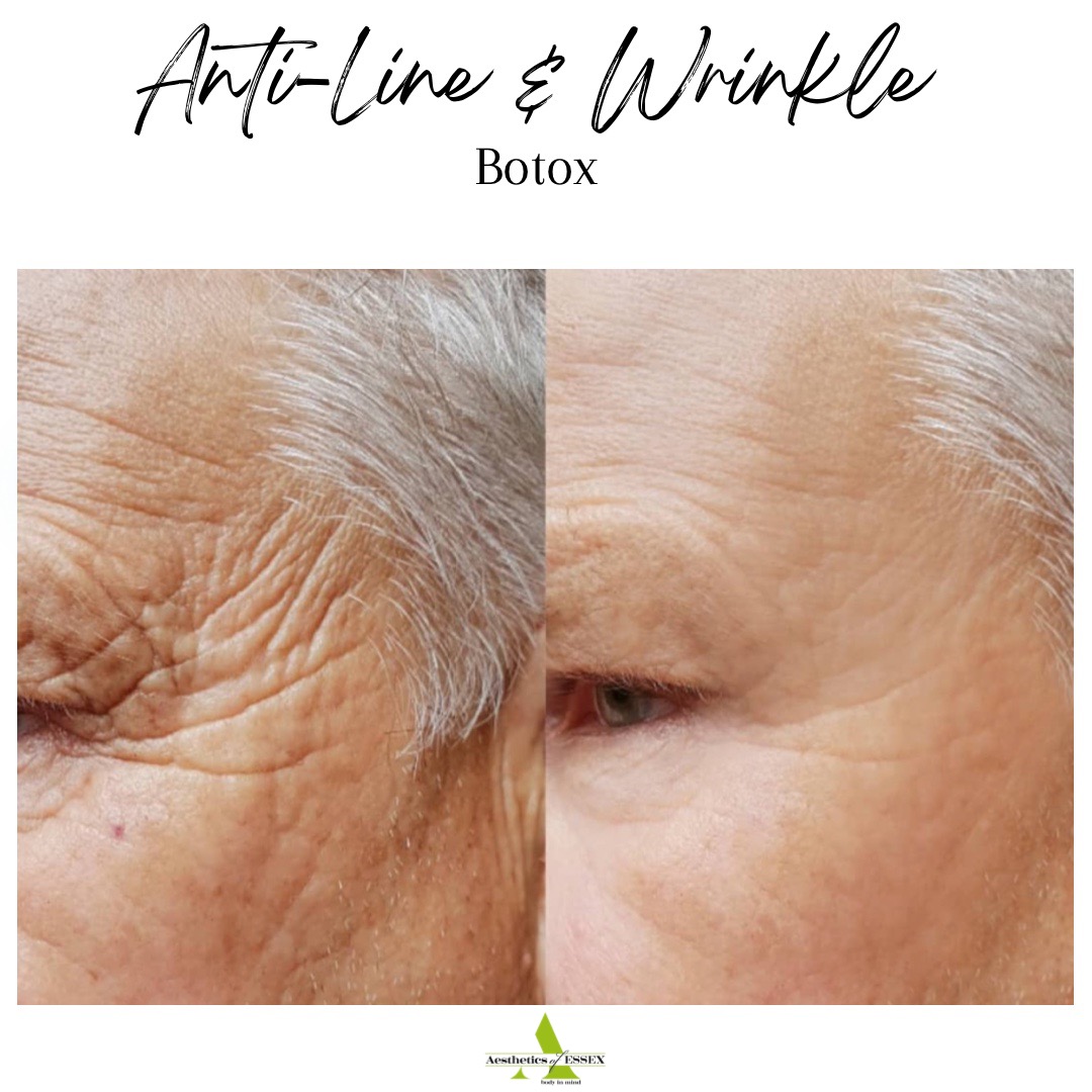 Anti-line and anti wrinkle treatments Essex