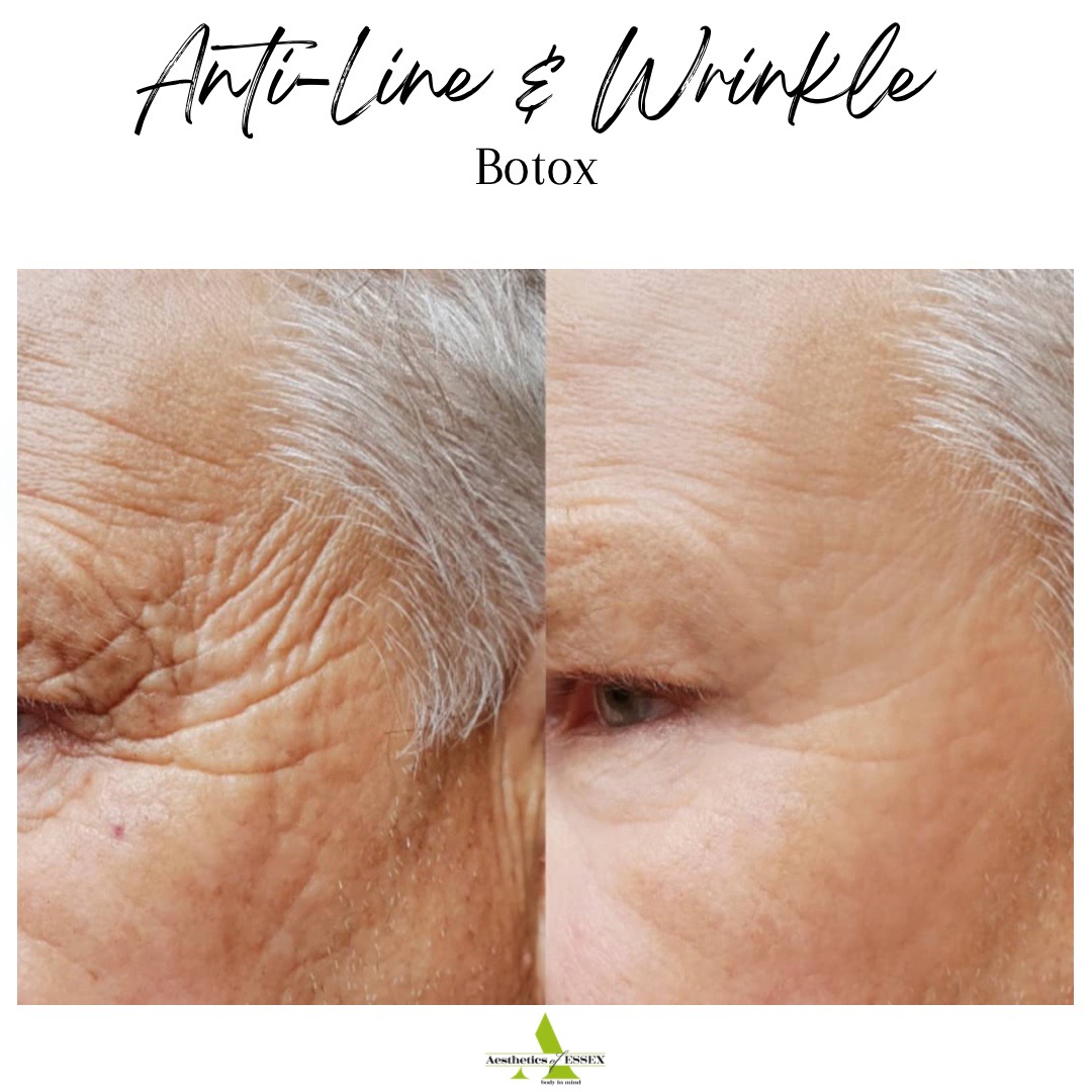 Anti Wrinkle Injections Essex Aesthetics of Essex