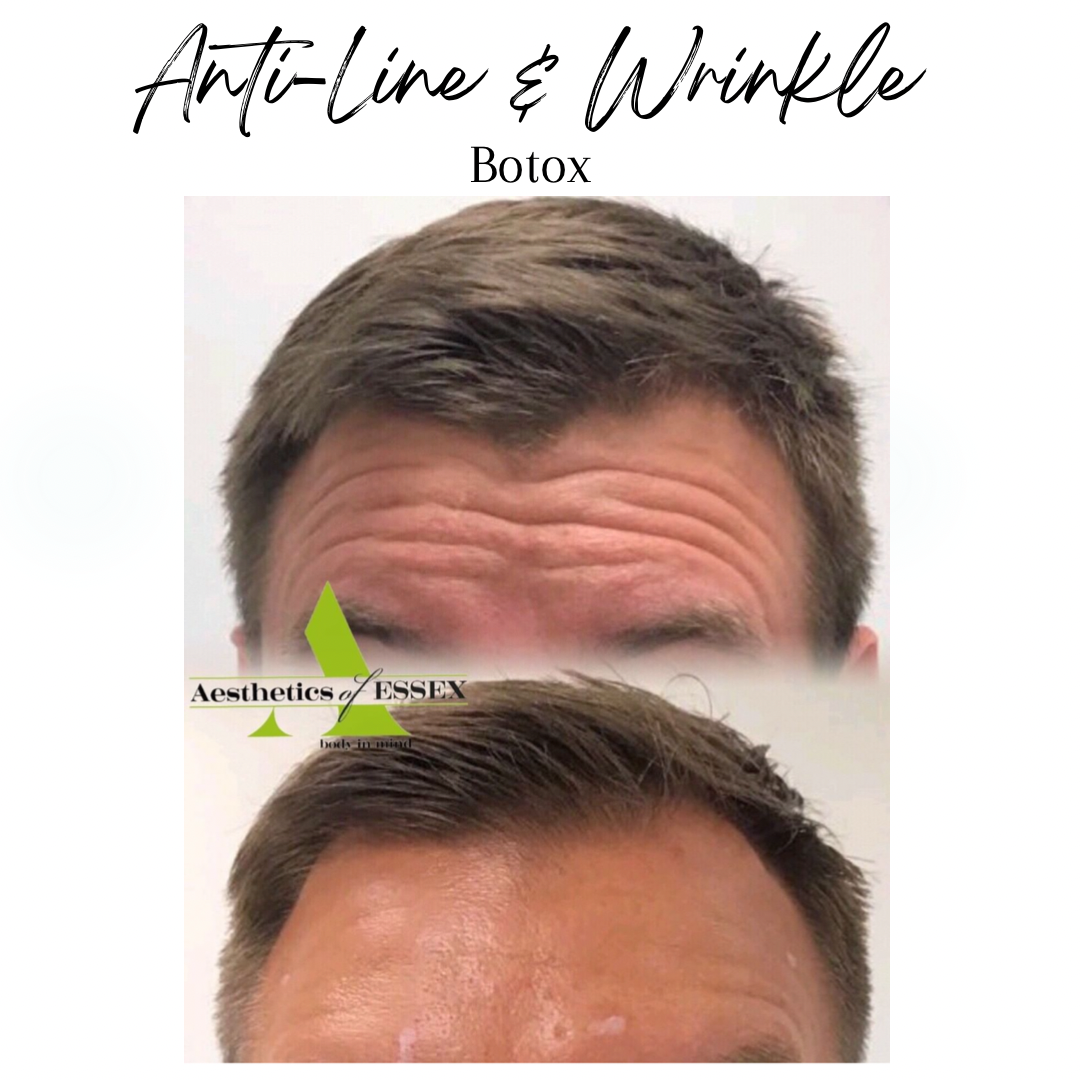 Anti-line and anti wrinkle injections Essex