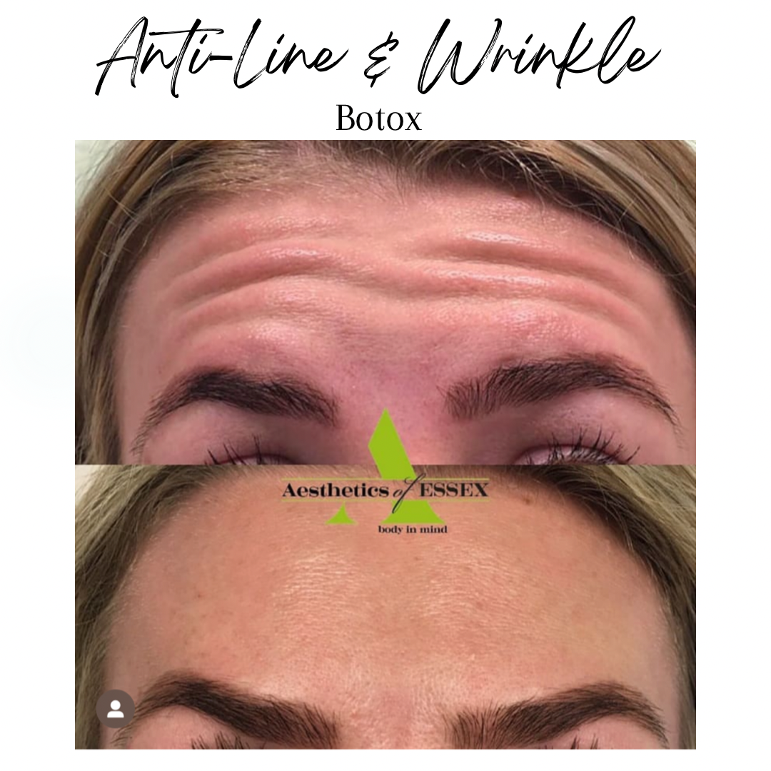Anti-line and wrinkle treatments Essex