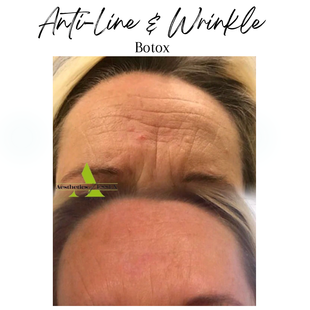 anti wrinkle injections essex