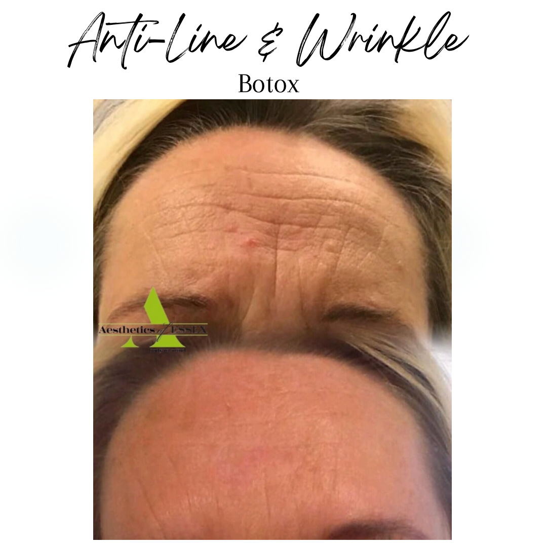 Anti Wrinkle Injections Essex Aesthetics of Essex