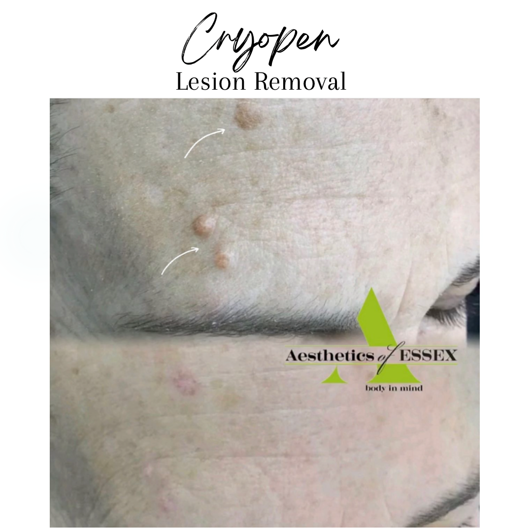Cyropen Lesion Removal