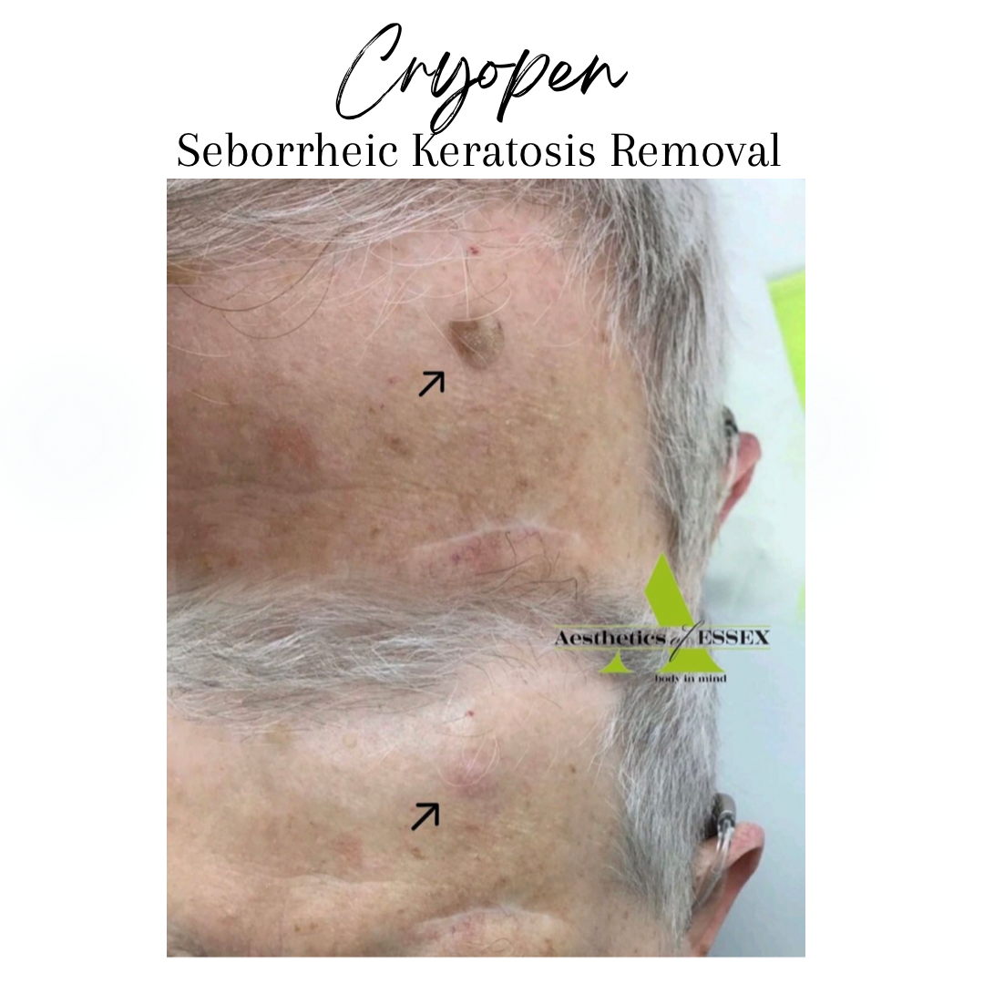 Cyropen Seborrheic Keratosis Removal