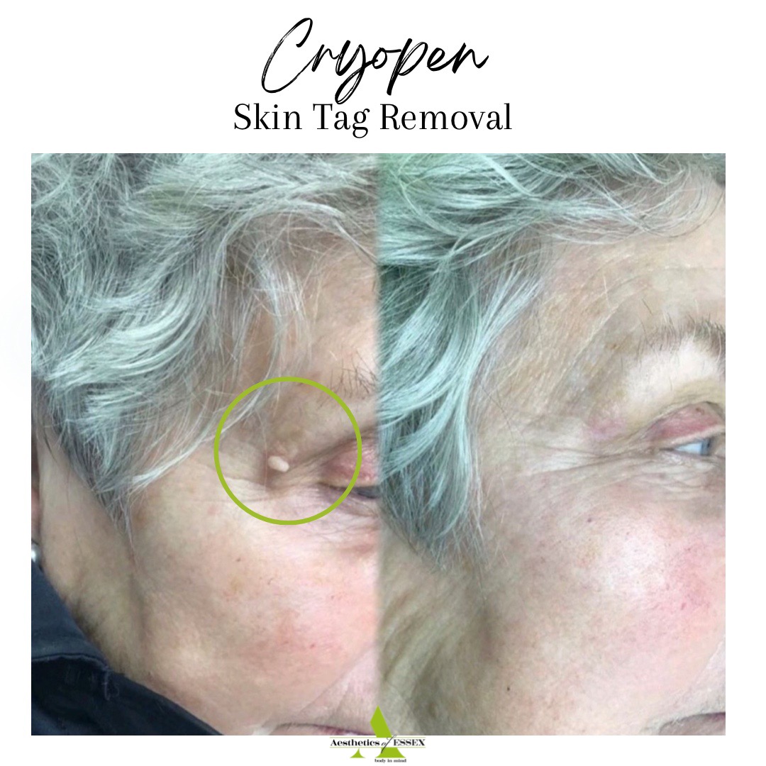 Cyropen Skin Tag Removal