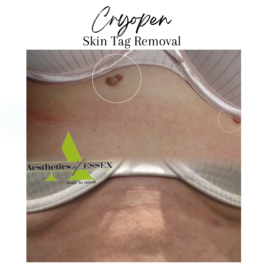 Cyropen Skin Tag Removal