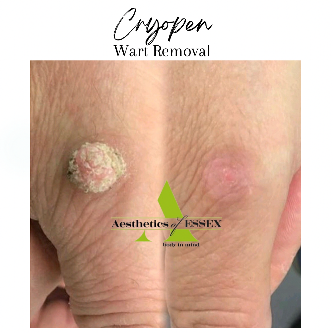 Cyropen Wart Removal