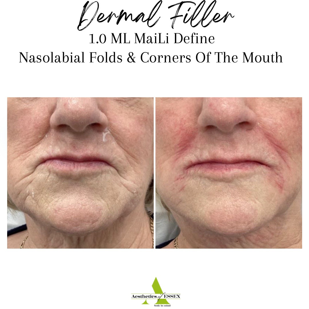 Nasolabial Folds and Corners Of Mouth - Aesthetics of Essex