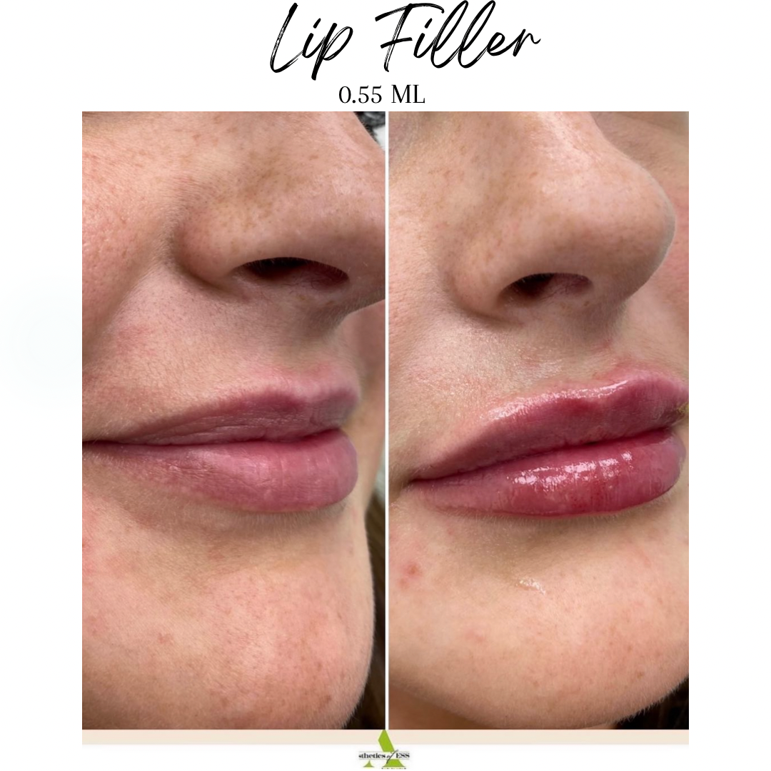 Lip Filler Essex