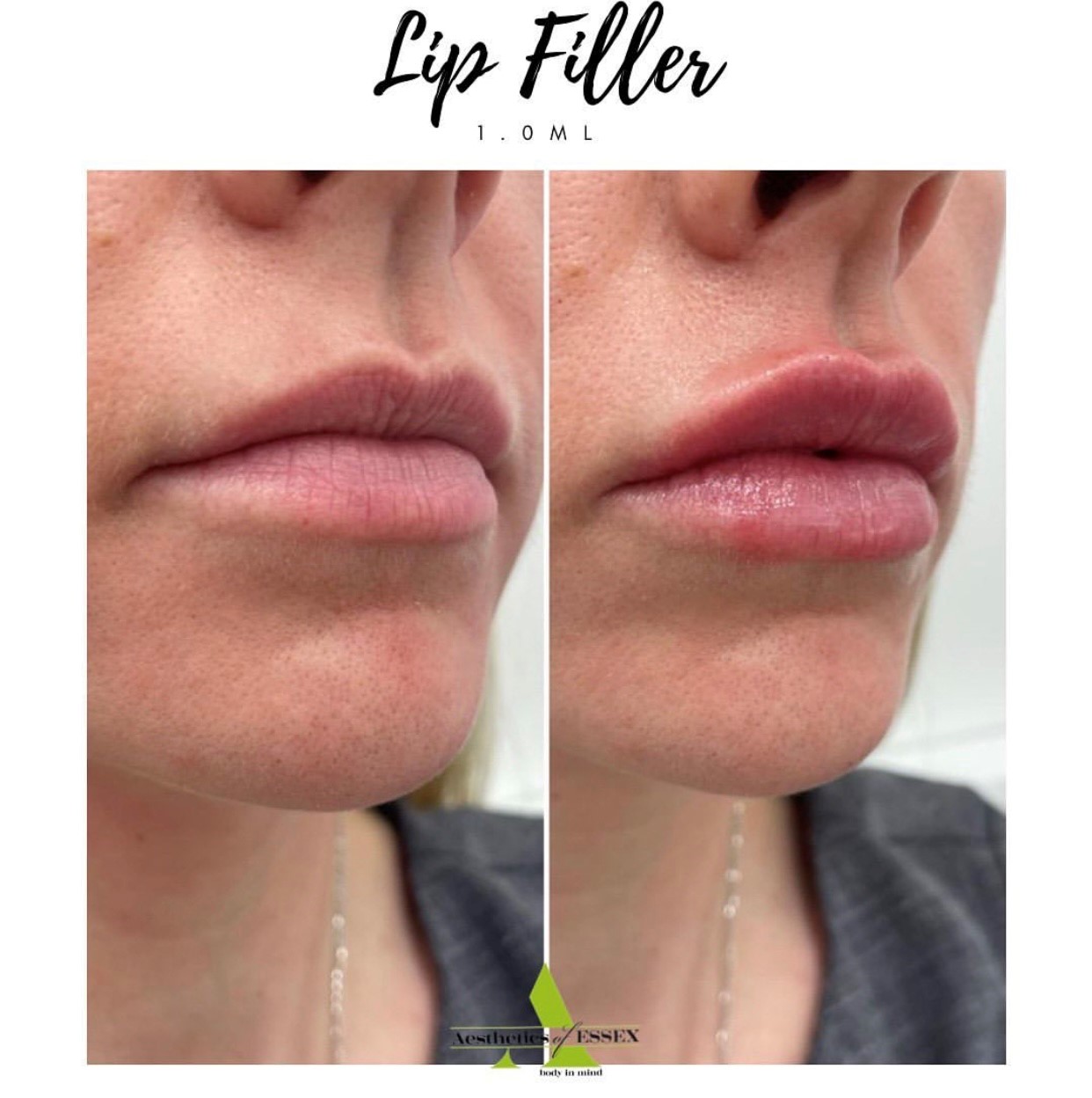 Lip Filler Essex