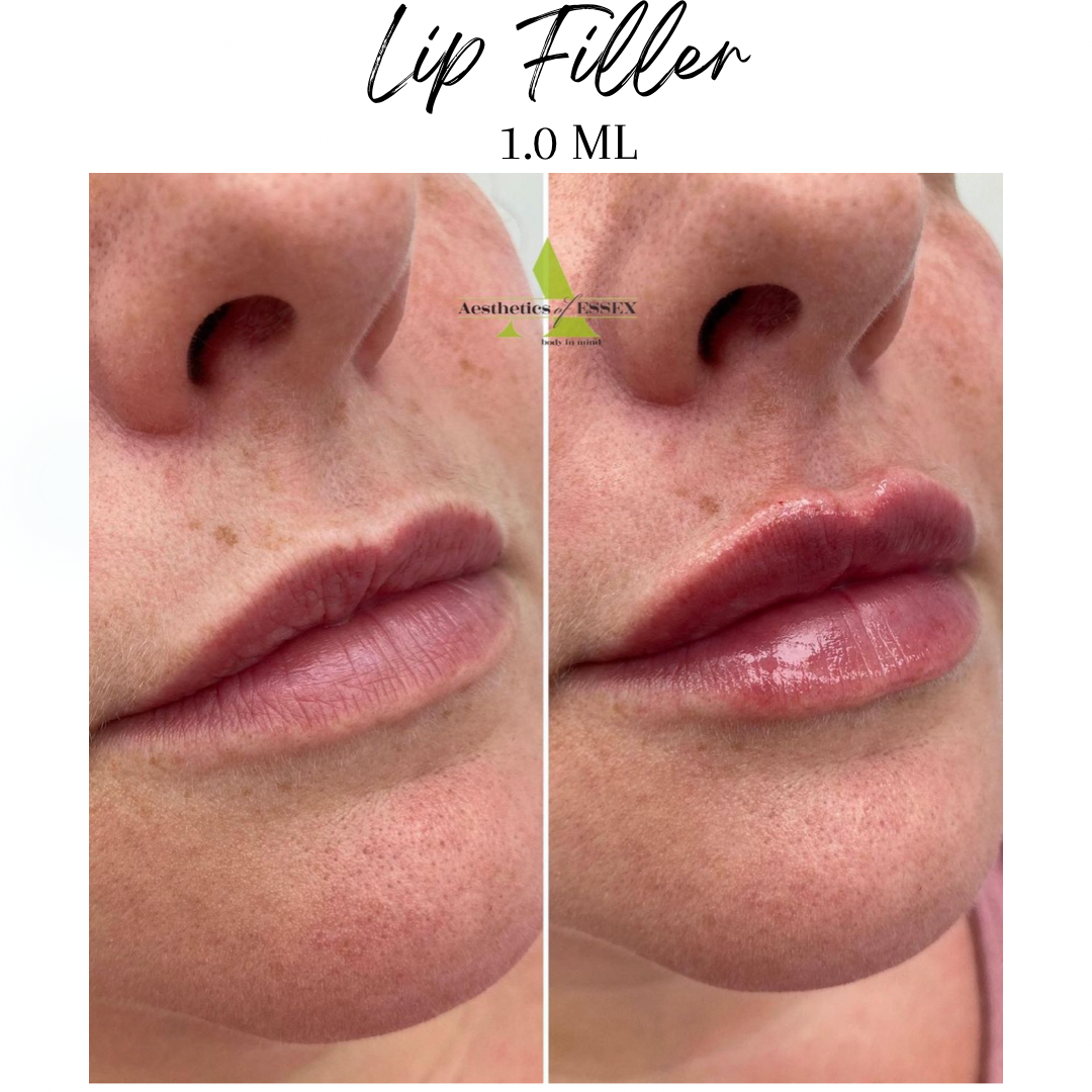 Lip Filler Essex