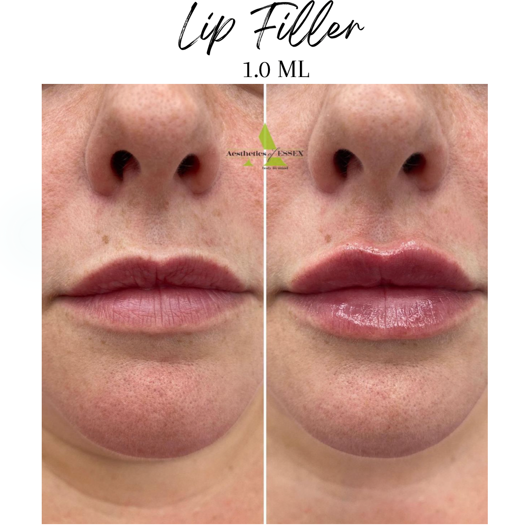 Lip Filler Essex