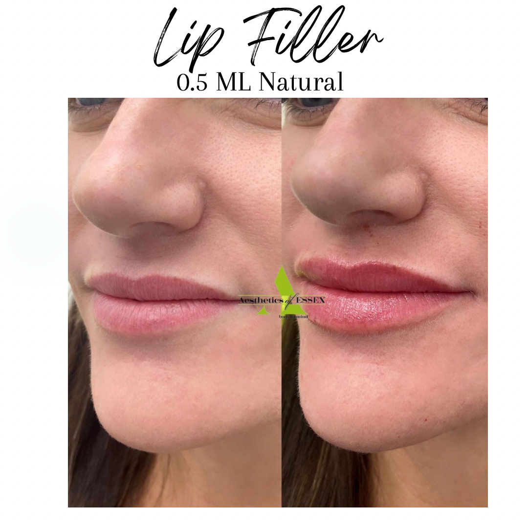 Lip Filler Essex