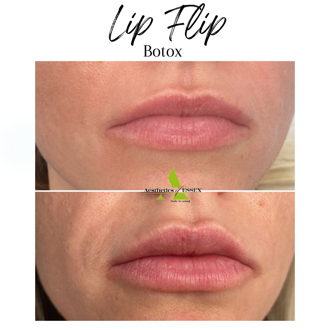 Lip Filler Essex