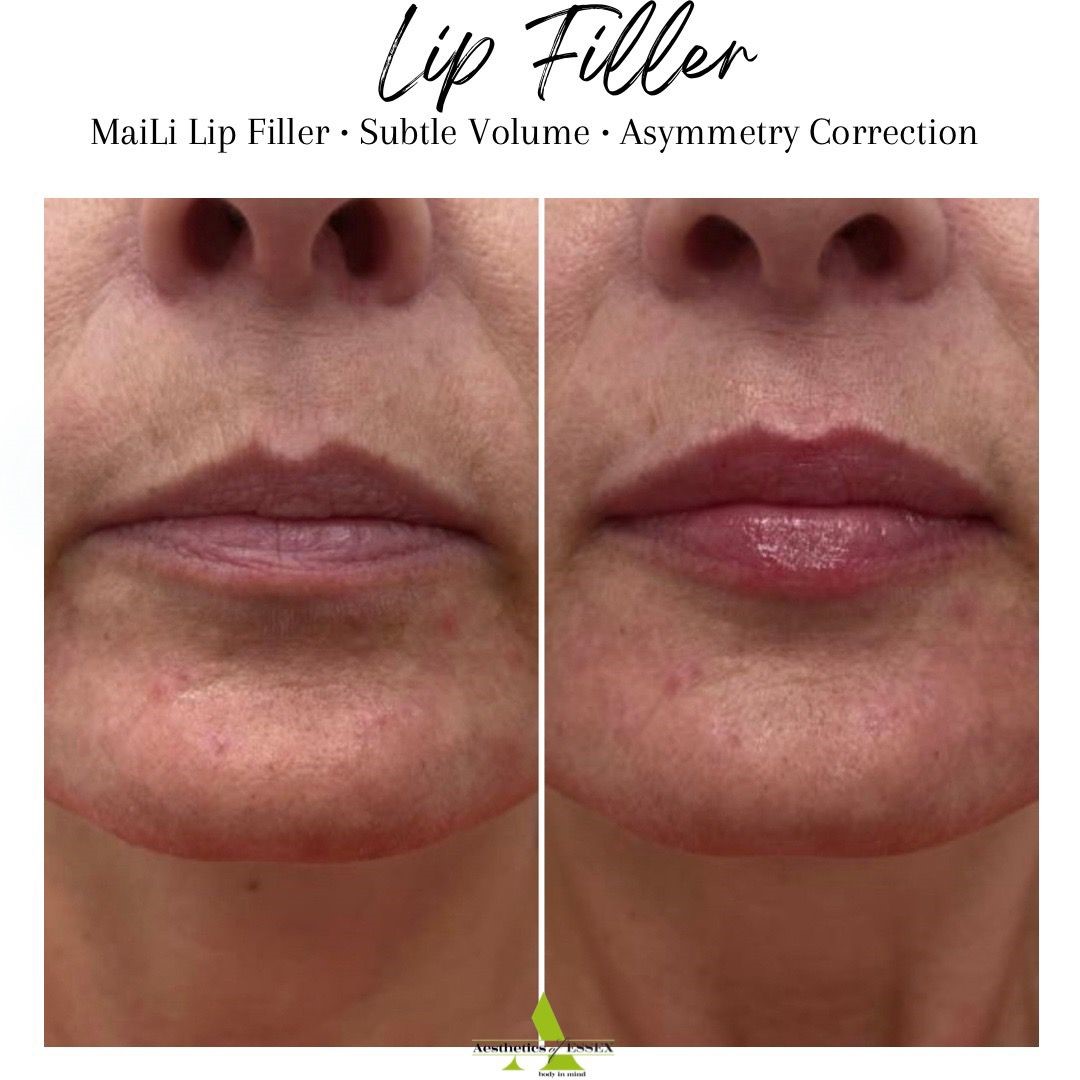 Lip Filler Essex