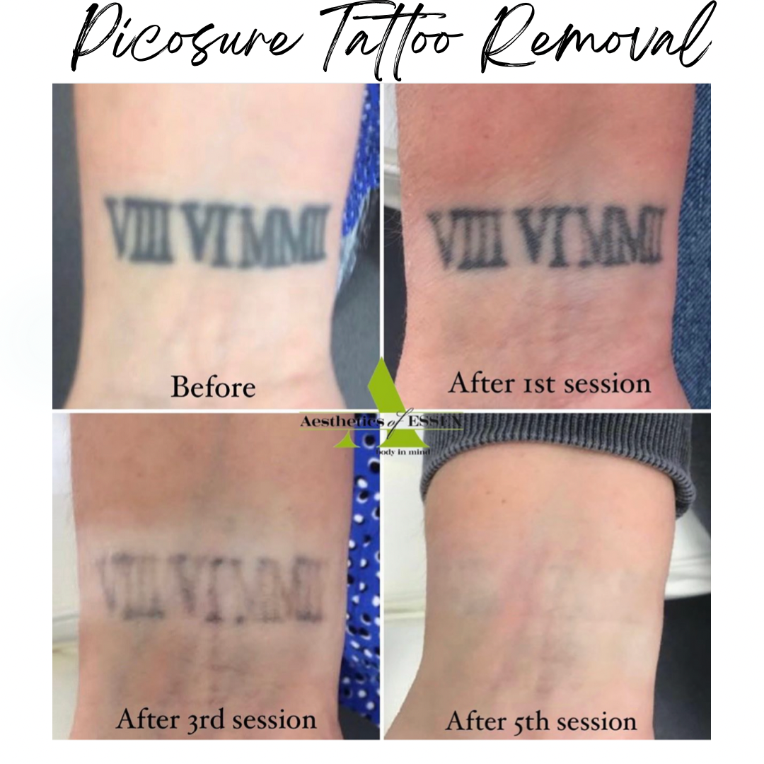 Tattoo Removal Progress What Results to Expect  Removery