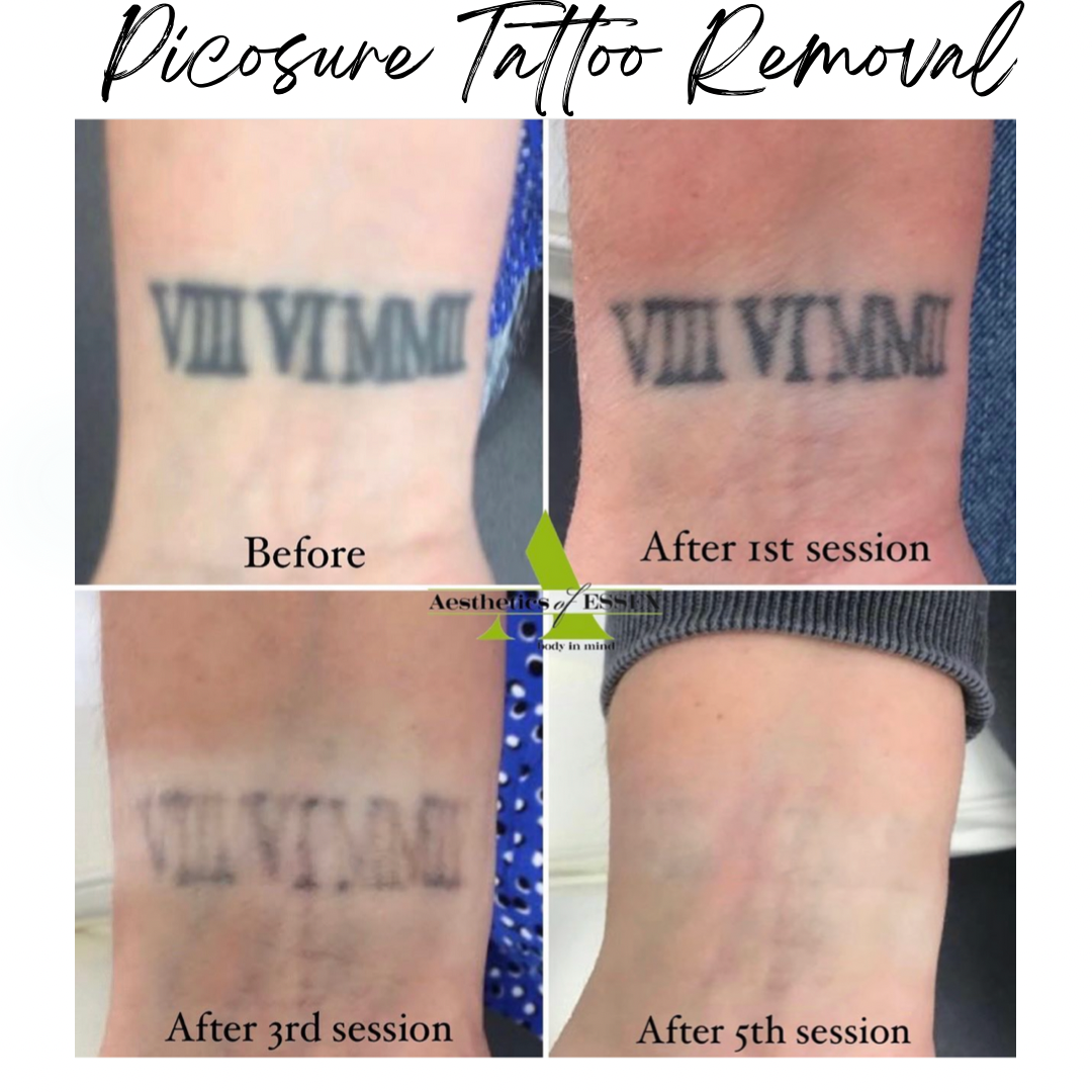 Laser tattoo removal  Nev Schulman came into our Brentwood location for  laser tattoo removal Watch to see how easy it is as he relaxes and enjoys  a session  By Advanced