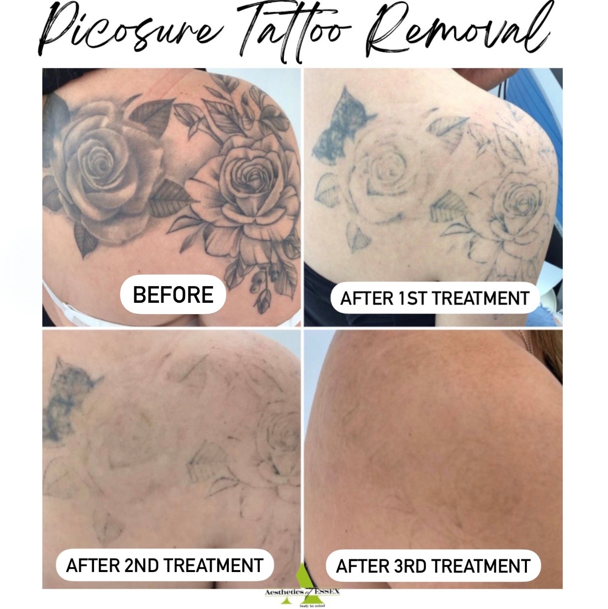 Sydney Laser Tattoo Removal — Here is a huge bicep tattoo that is making  way for...