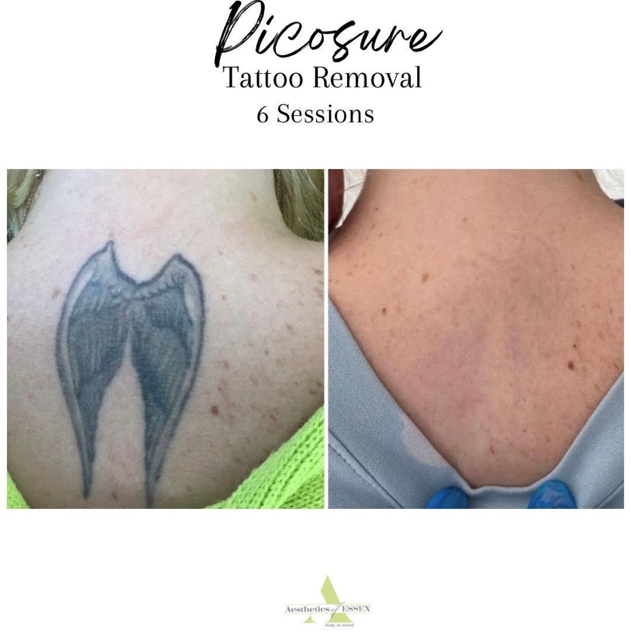 Picosure Tattoo Removal Essex