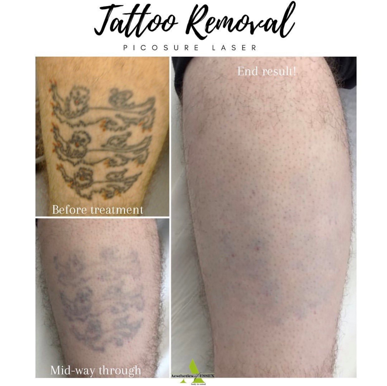 PicoSure Tattoo Removal UK  Andrea Catton Laser Clinic Burnley