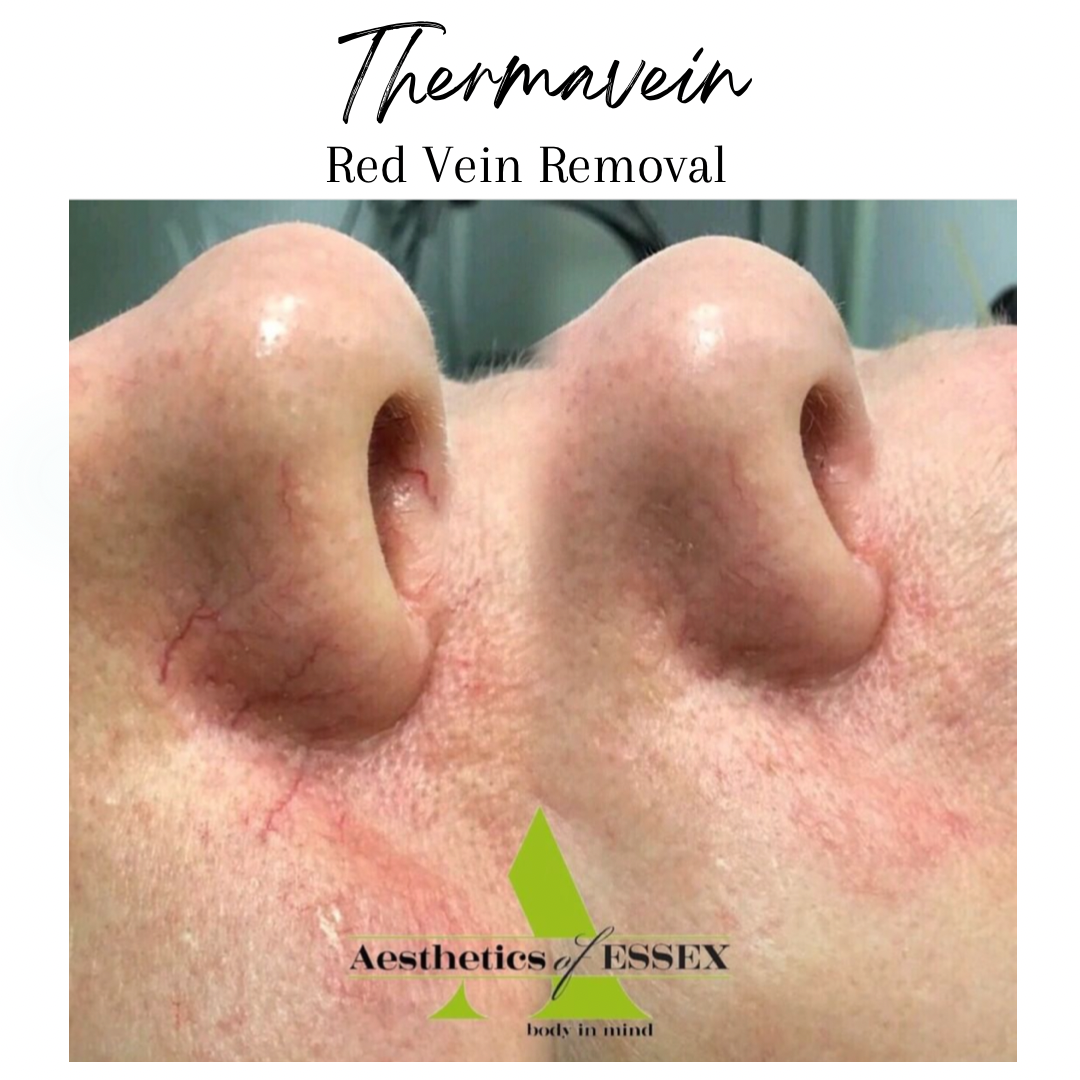 Thermavein Red Vein Removal