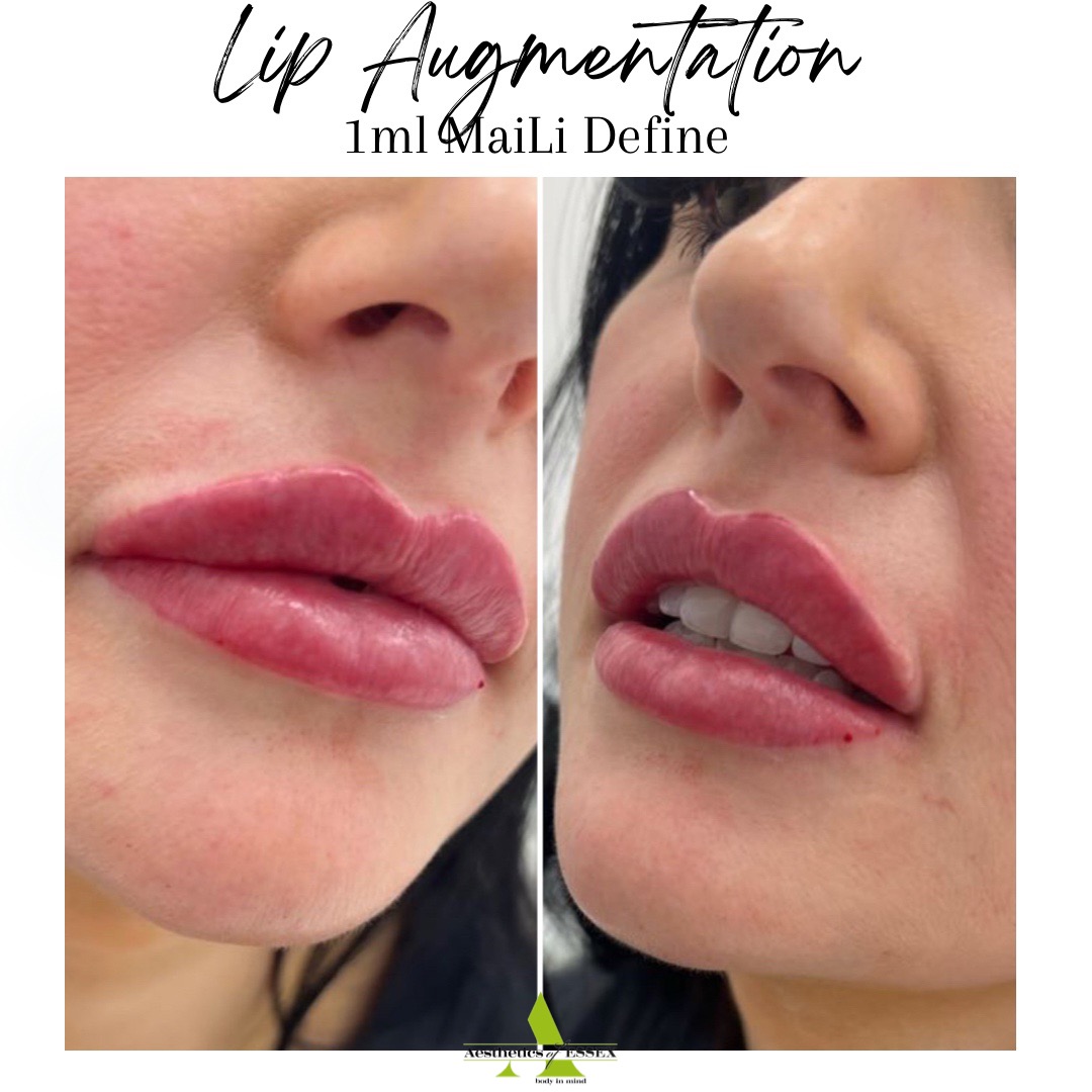 Lip Augmentation - Lip Filler - Aesthetics of Essex