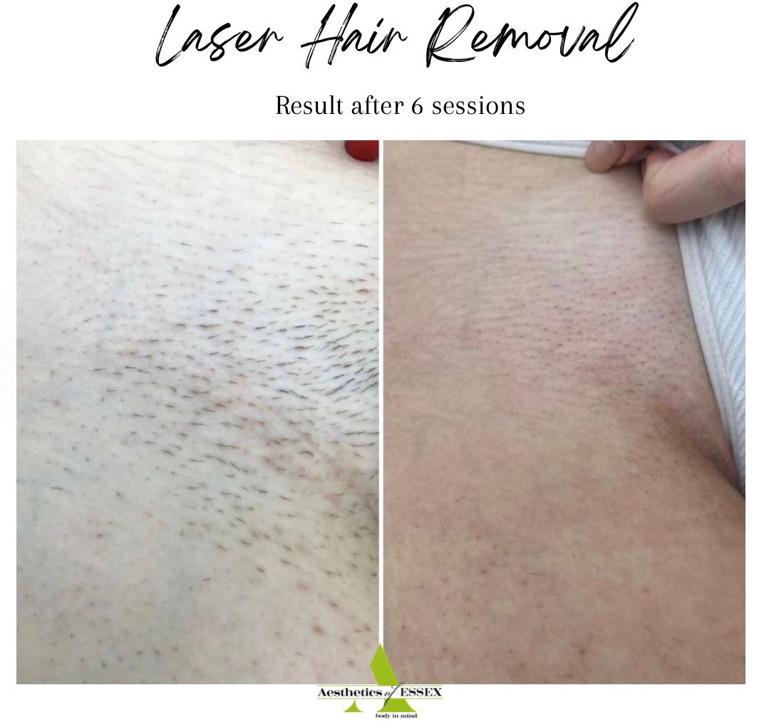 Laser Hair Removal at Aesthetics of Essex