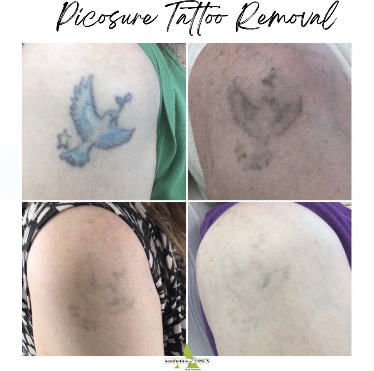 Tattoo Removal Before and After