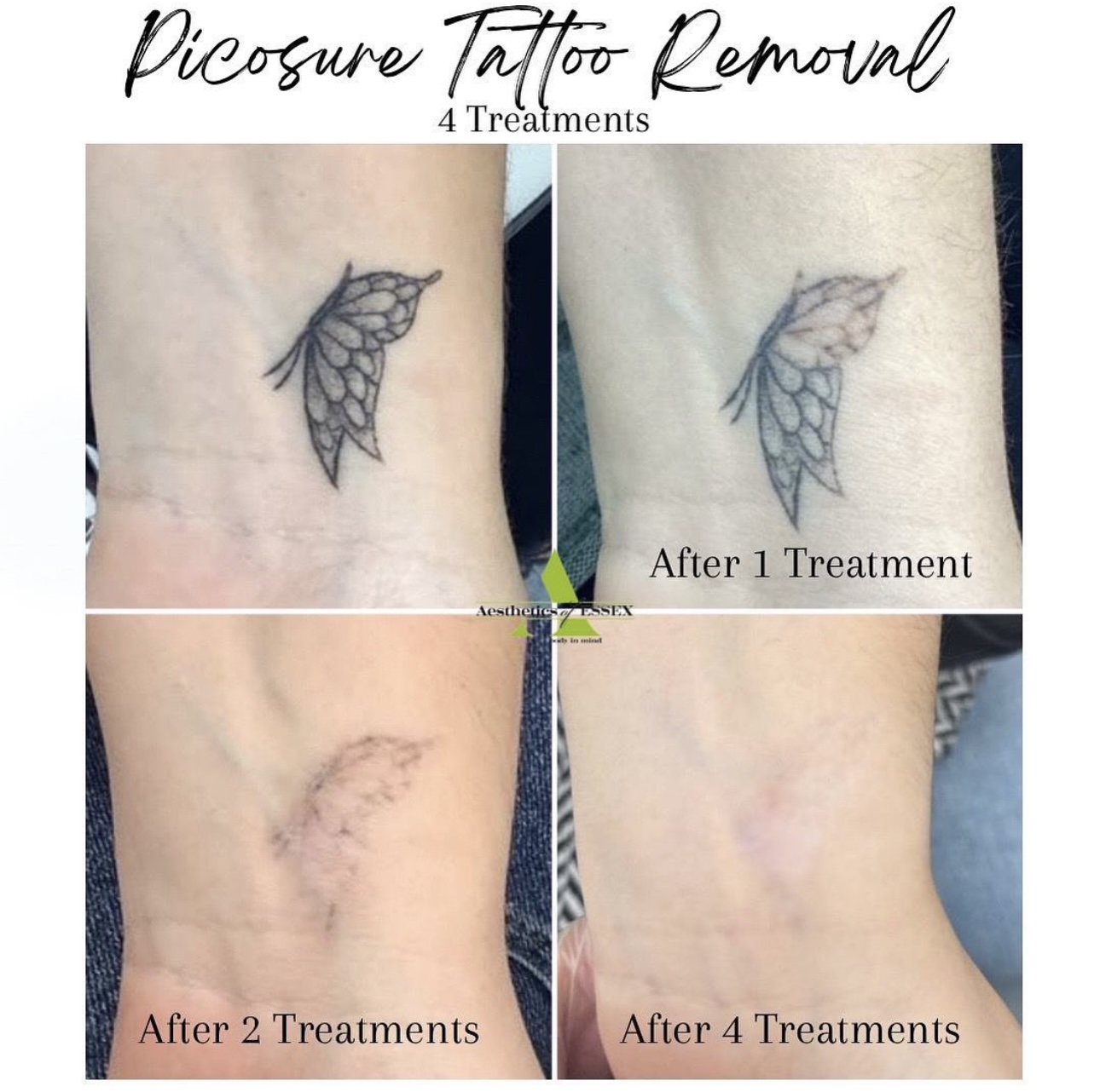 Picosure Laser vs Q Switch Tattoo Removal · Lynton Clinic