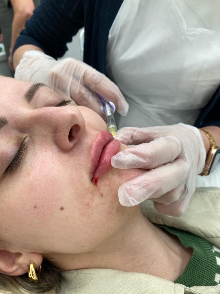 lip filler