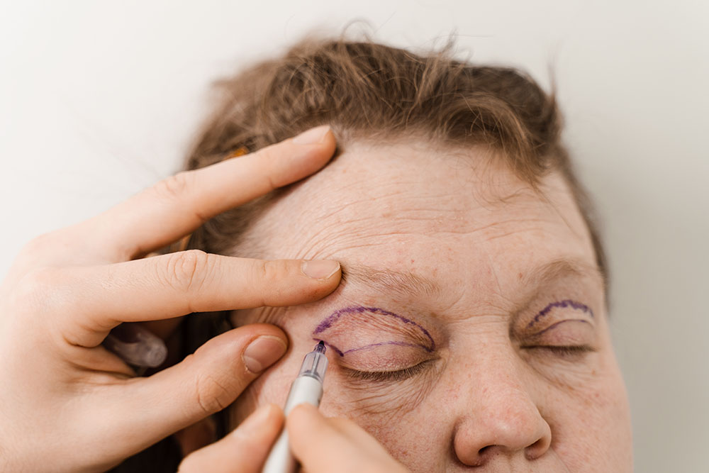 blepharoplasty