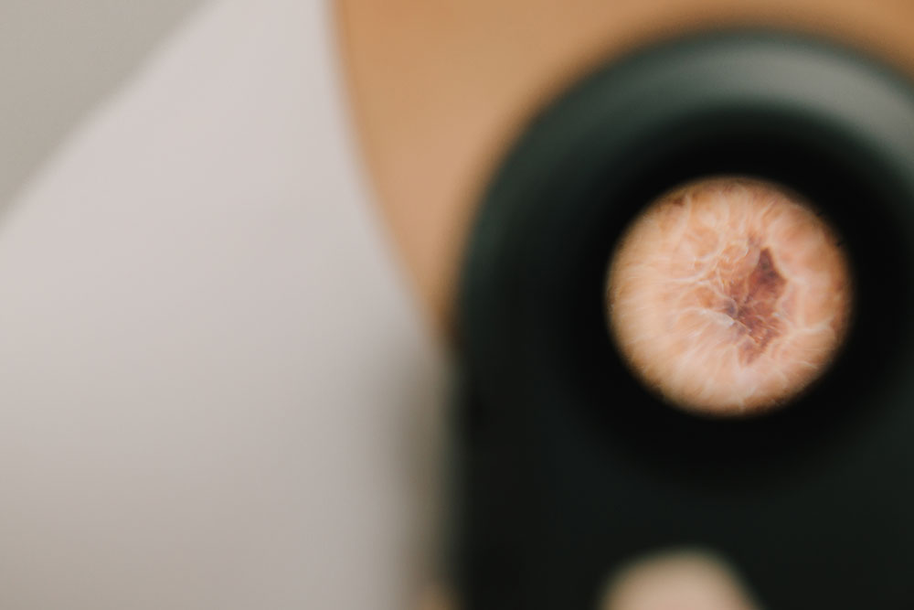 dermascope