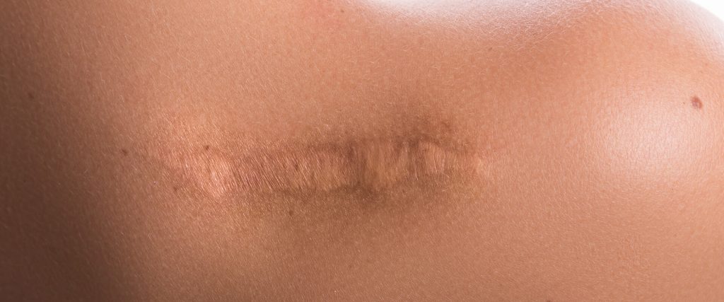 Keloid Scar