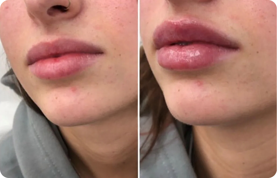 Lip fillers treatment at Aesthetics of Essex