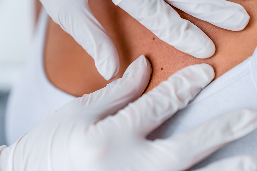 Lipoma removal