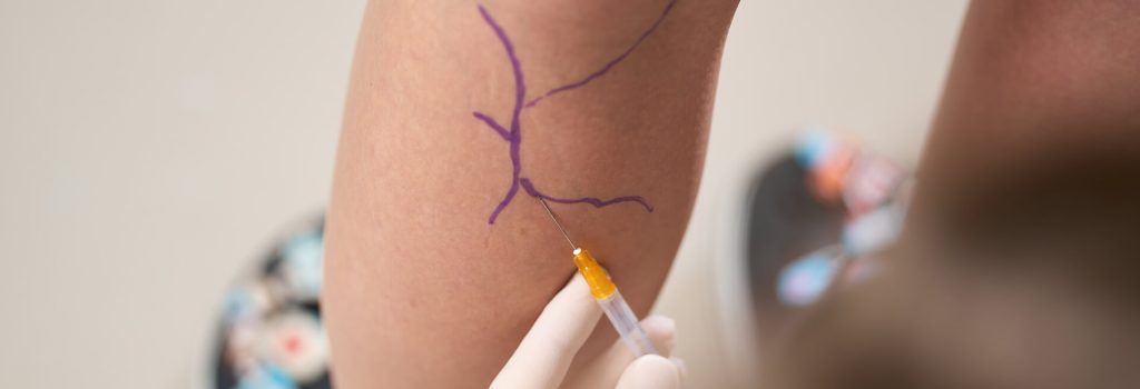 sclerotherapy