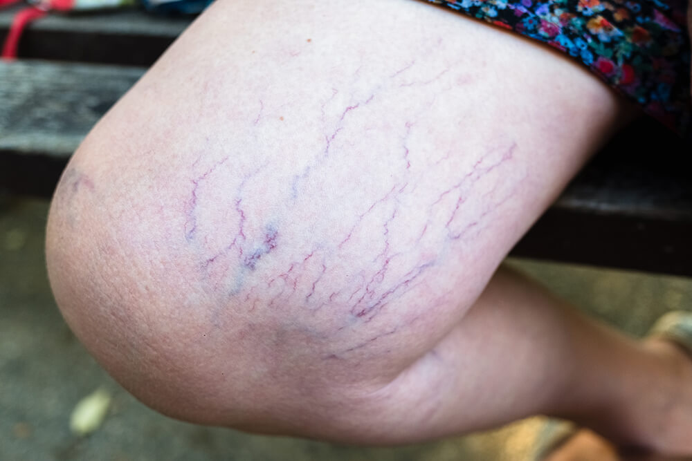 sclerotherapy