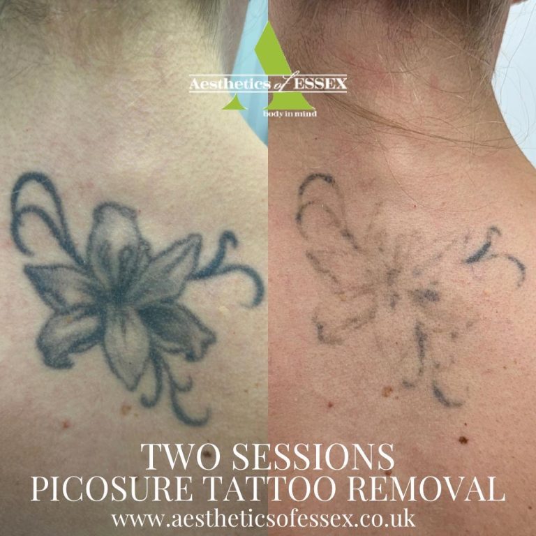 picosure