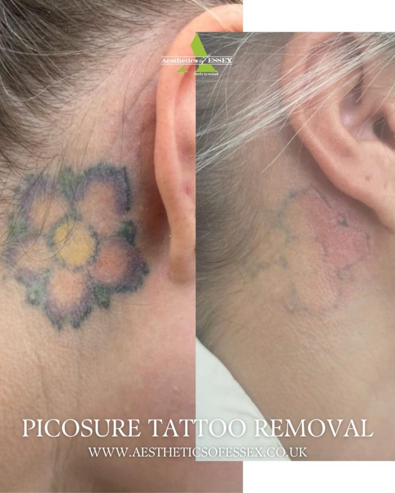 picosure