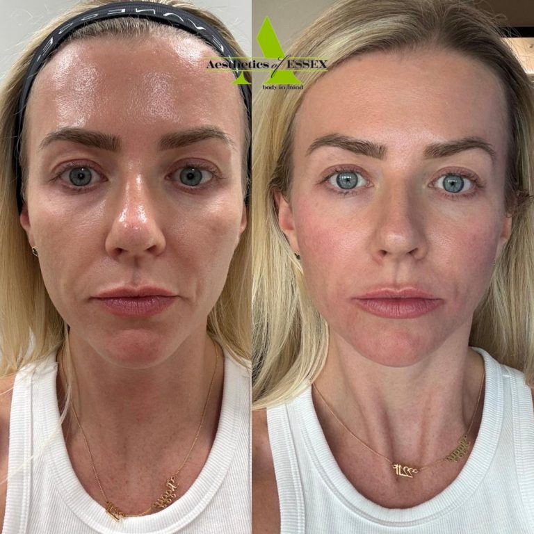 dermal filler