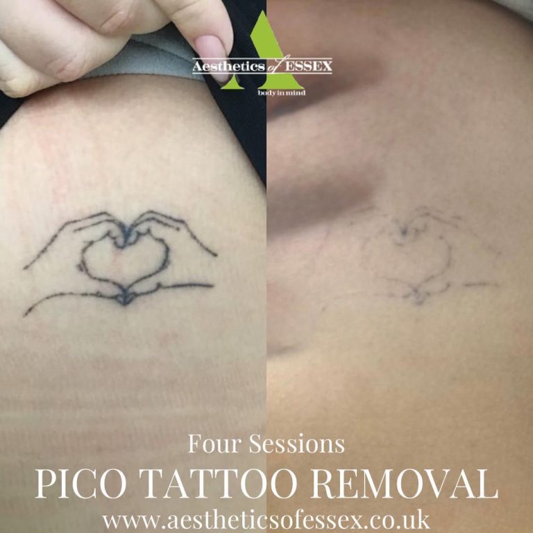 picosure