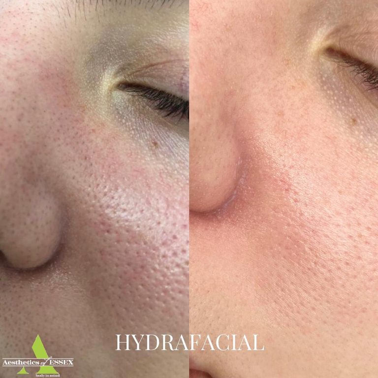 hydrafacial