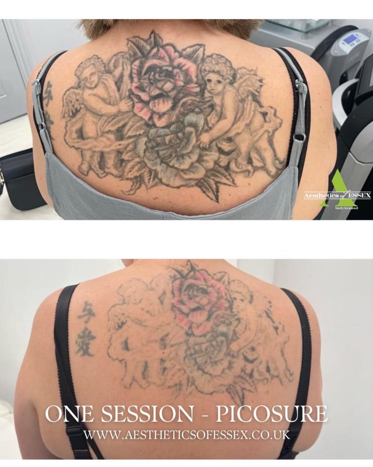 picosure