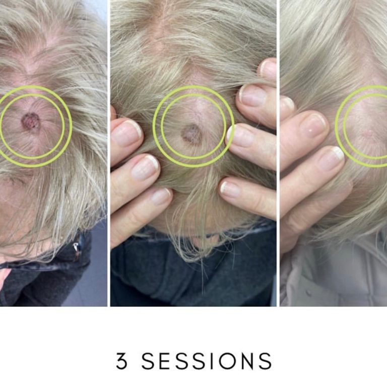 Cryopen before and after results for mole removal at Aesthetics of Essex